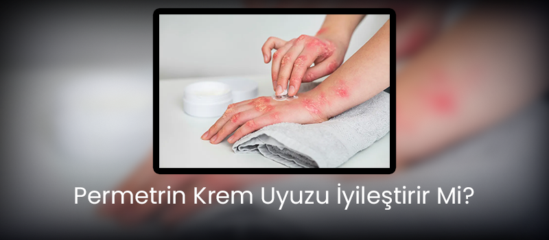 Permetrin Krem Uyuzu İyileştirir Mi