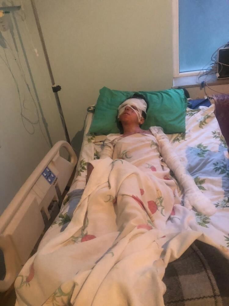 Düğün öncesinde genç çiftin elleri kapandı! Yüzük takamaz, el ele tutuşamaz hale geldiler