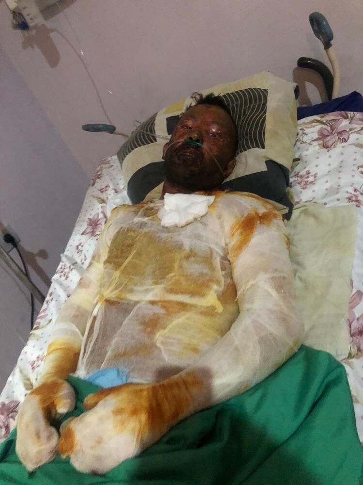 Düğün öncesinde genç çiftin elleri kapandı! Yüzük takamaz, el ele tutuşamaz hale geldiler