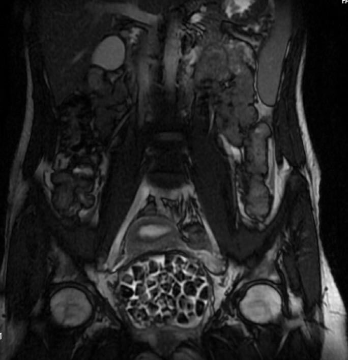 Hepsi genç kızın vücudundan çıkarıldı! Saya saya bitiremeyen doktorlar şok oldu