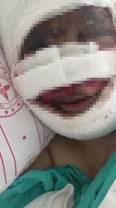 Bağlanıp başından kimyasal madde dökülen kadın yaşam mücadelesi veriyor