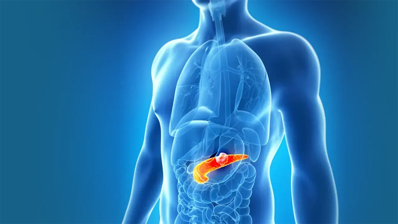 Pankreas Kanseri Tedavi