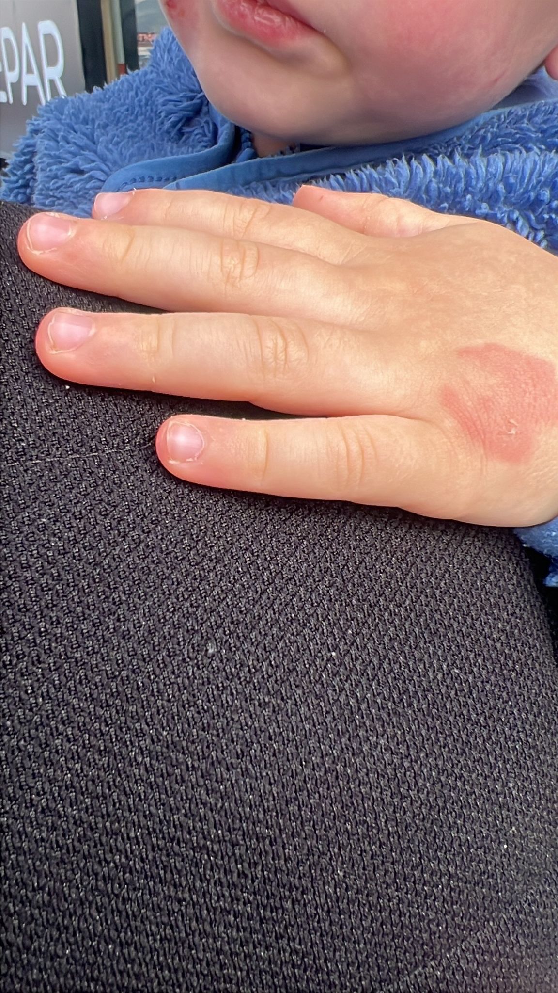 Kreşte Skandal Iddia Aile Çocuğunu Darp Edilmiş Halde Buldu (5)