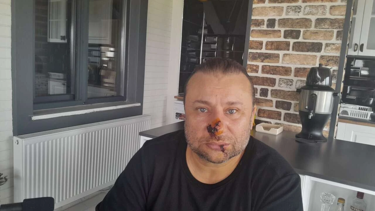 Onur Akay’ın Yüzünü Tanınmaz Hale Getiren Hastalık Ne