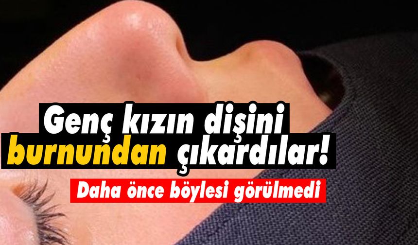 Genç kızın dişini burnundan çıkardılar! Daha önce böylesi görülmedi